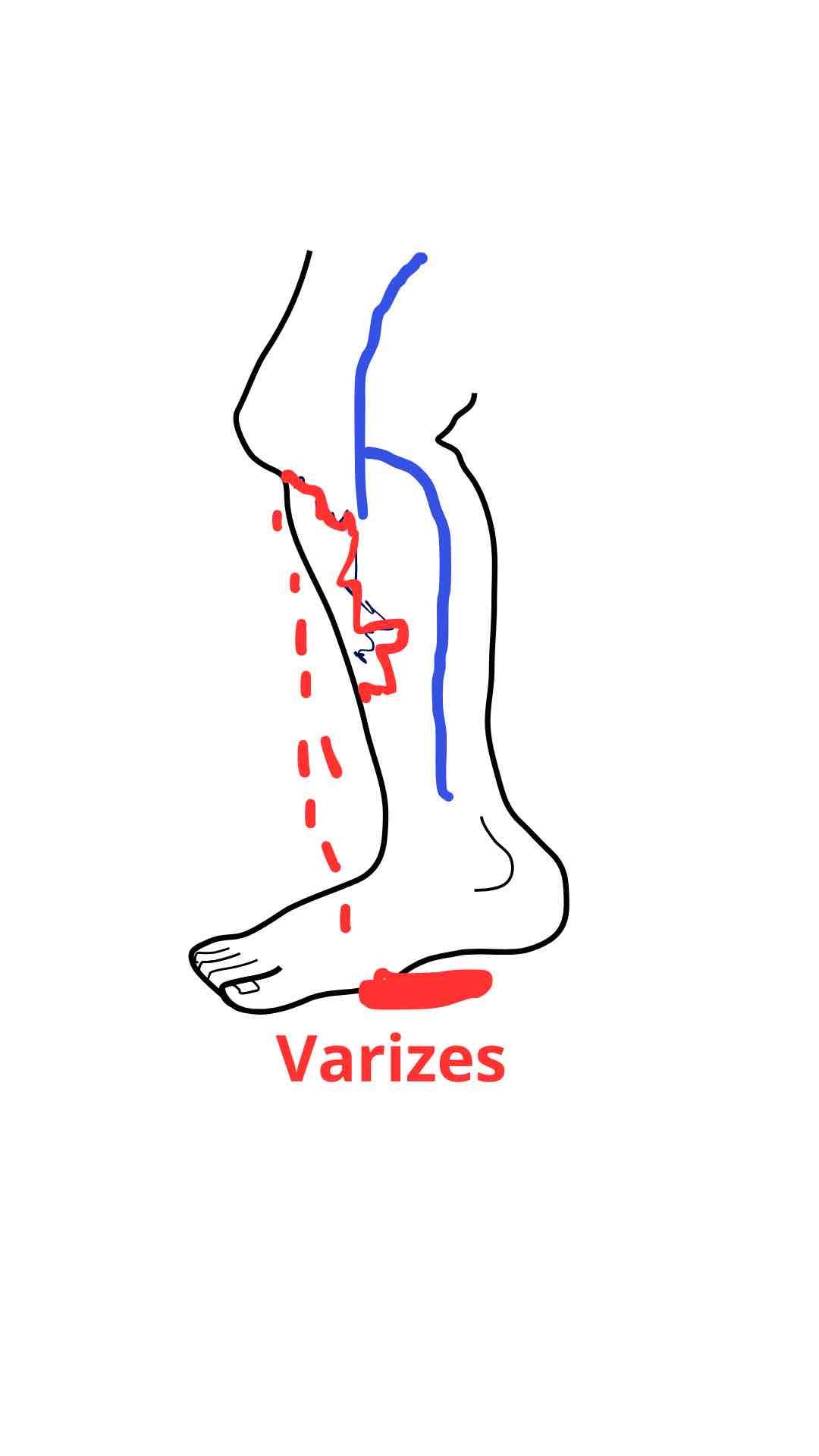 Varizes sangram: Varicorragia