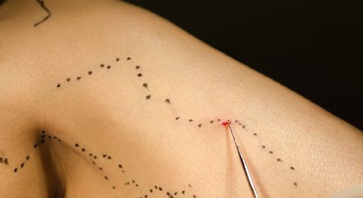 Microcirurgia de Varizes o que você precisa Saber