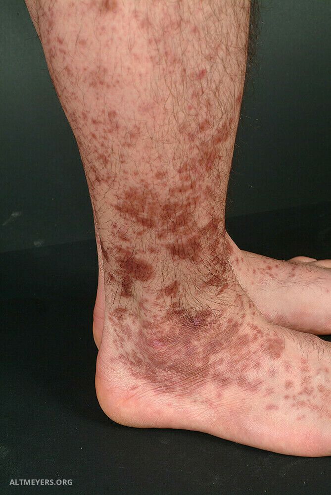 Dermatite ocre: Manchas escuras nas pernas