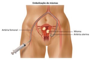 Embolização de Mioma