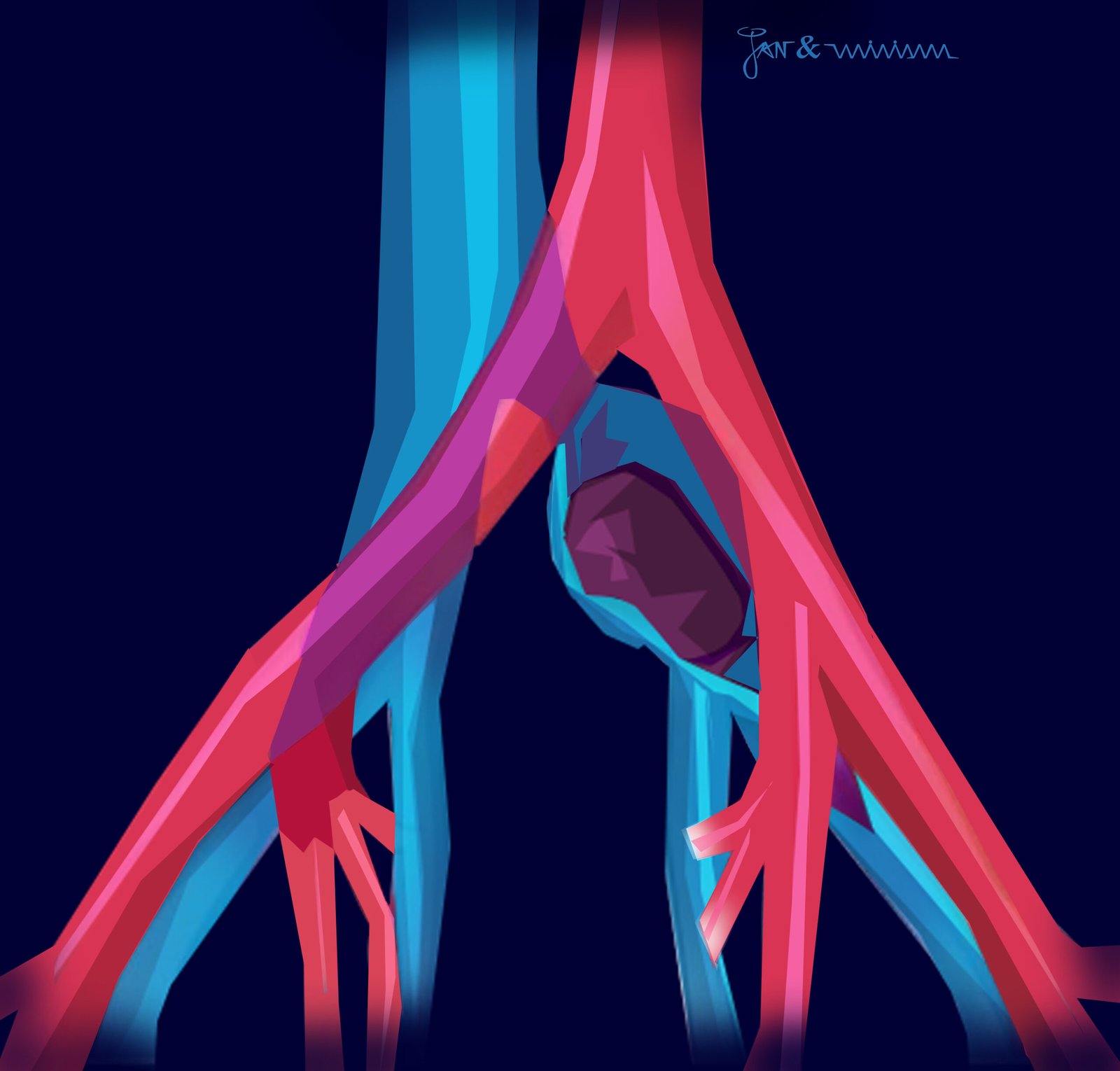 Síndrome de May-Thurner